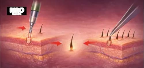 FUE Hair Transplant Guide: Benefits, Risks & Recovery