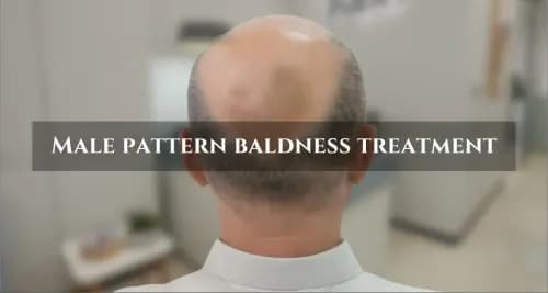 Male Pattern Baldness: FUE Treatment Options in 2026