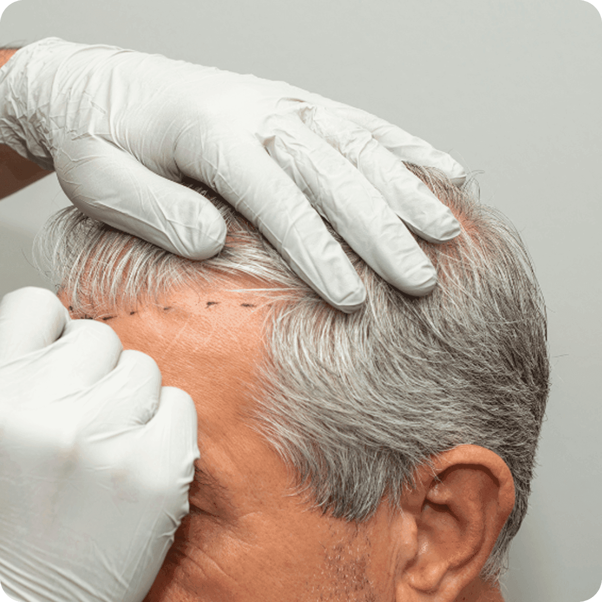Corrective hair transplant procedure fixing poor previous results