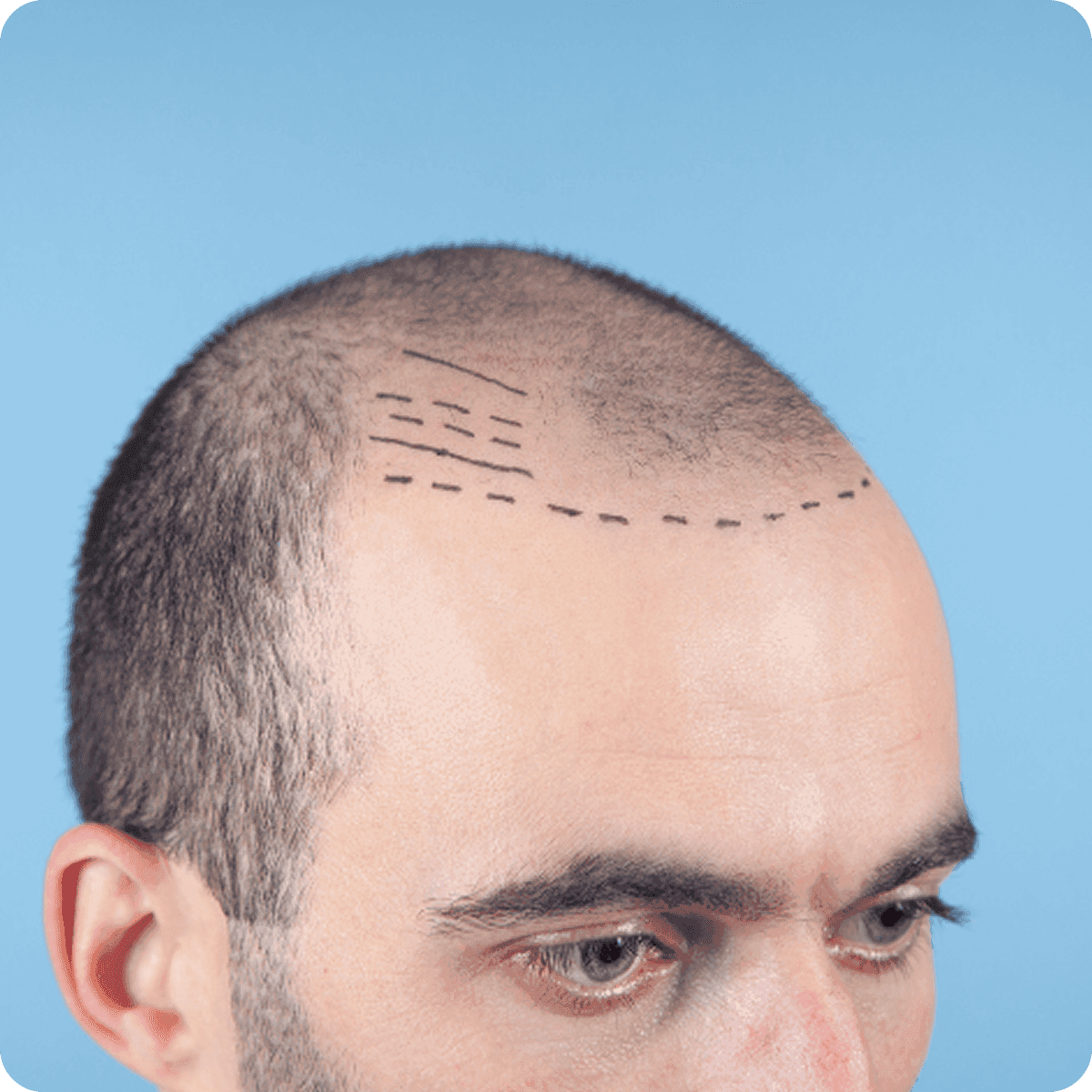 Hairline correction procedure showing natural front hairline design