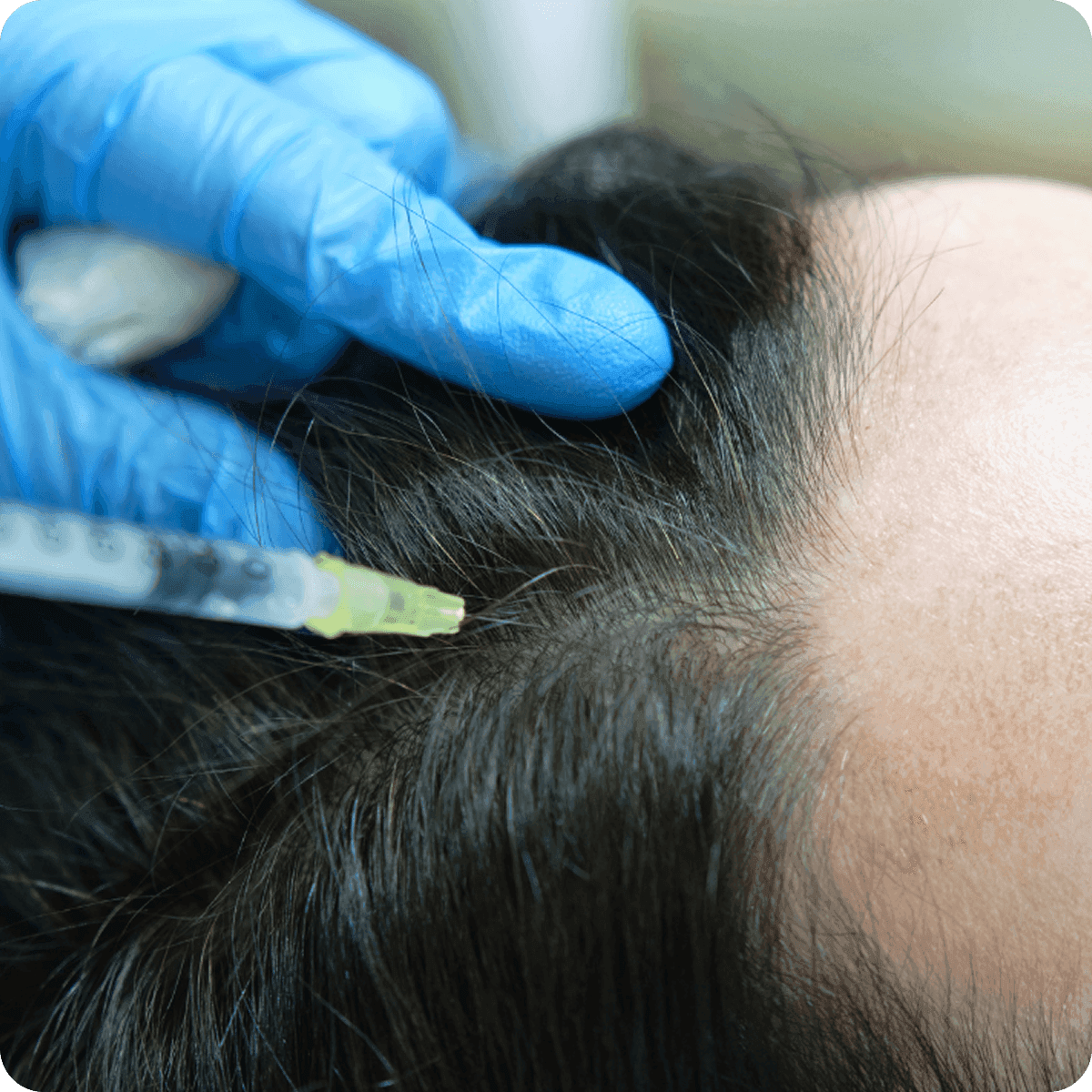 Mesotherapy treatment for hair loss showing injection therapy